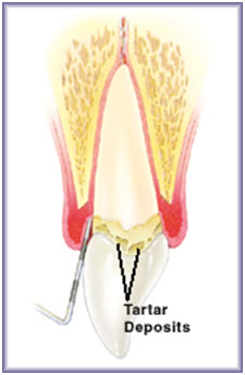 Cirugia periodontal Caguas